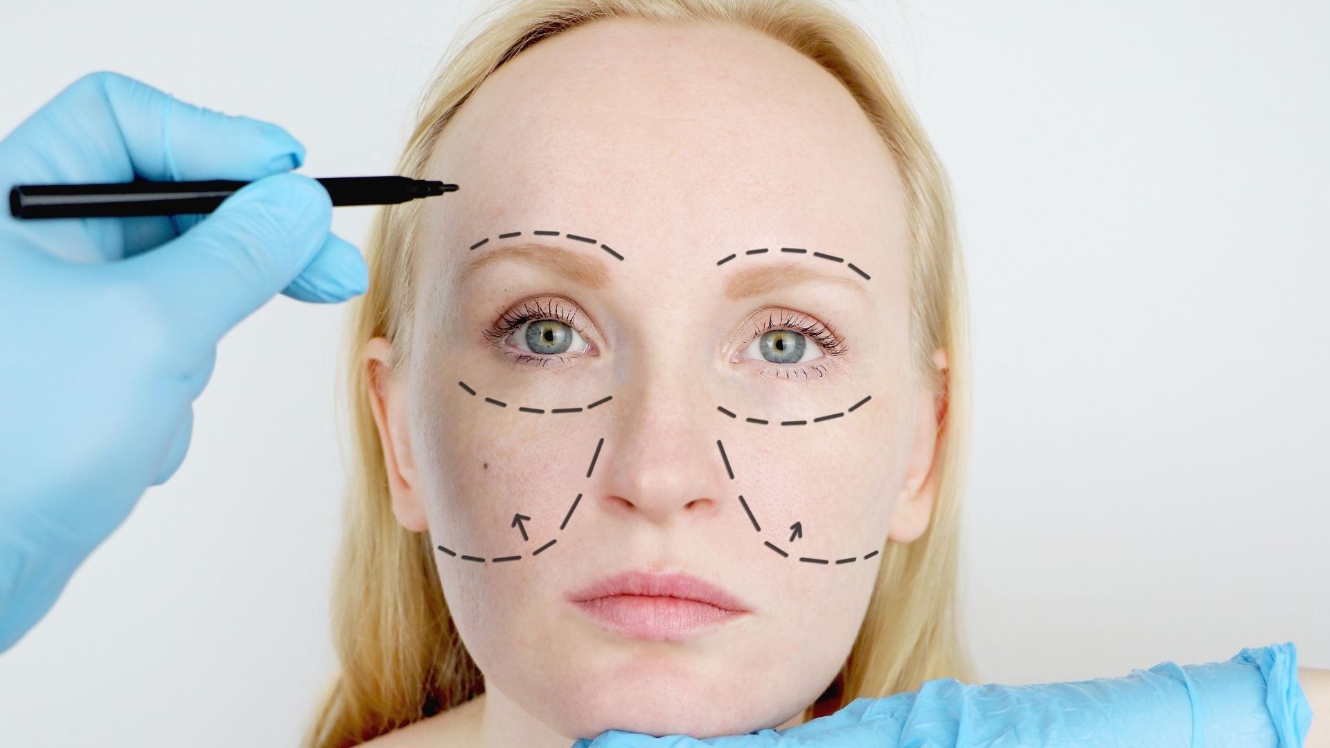 Rhytidectomy Surgery Cost Bergen County NJ