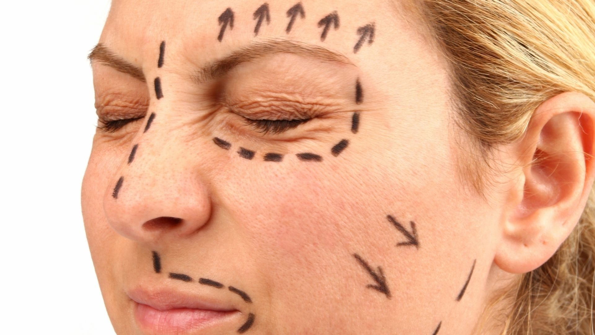 Rhytidectomy Surgery Cost Bergen County NJ